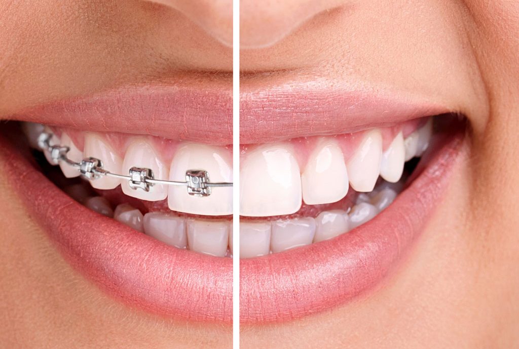 Care sunt cele mai utilizate tipuri de aparate dentare?