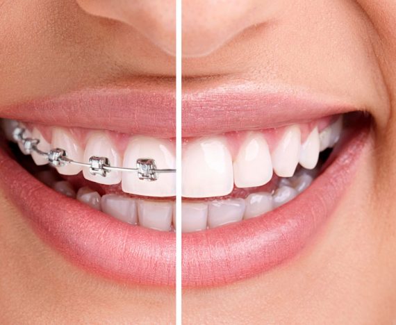 Care sunt cele mai utilizate tipuri de aparate dentare?