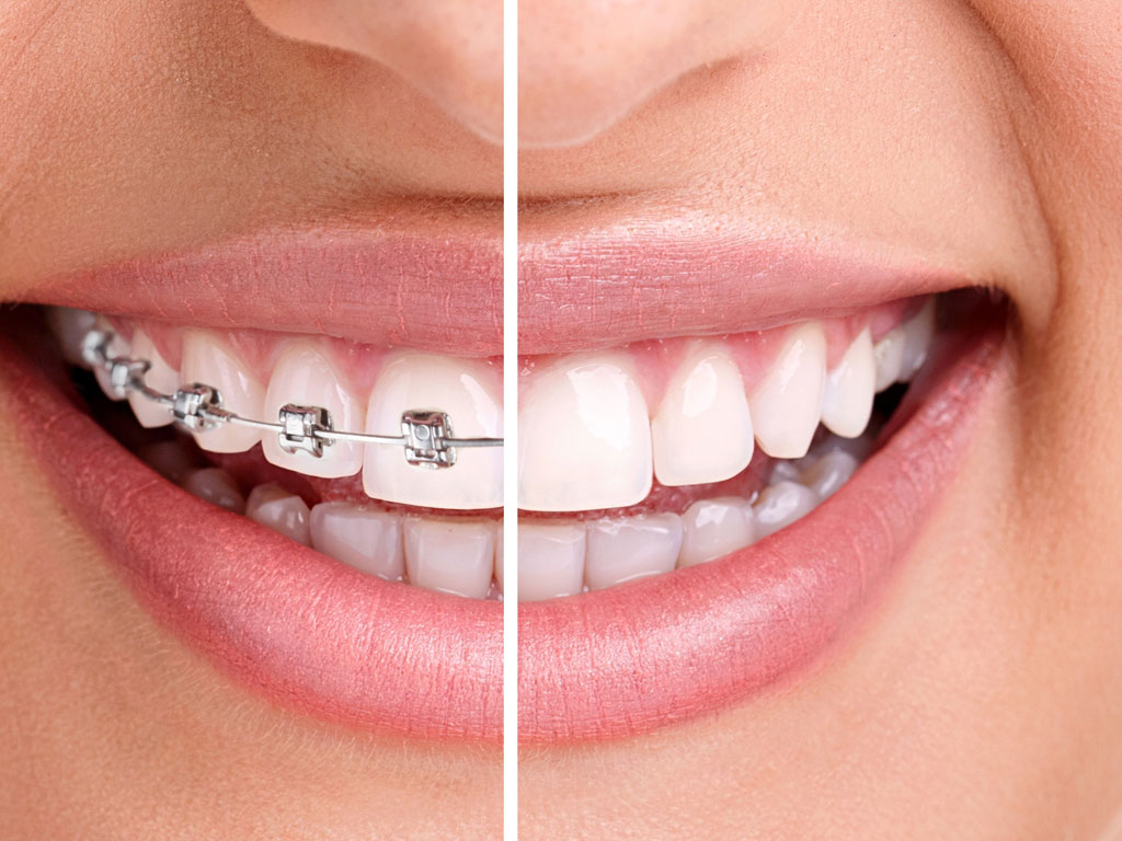 Care sunt cele mai utilizate tipuri de aparate dentare?