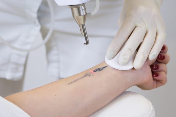 Cum se face indepartarea tatuajelor cu laser?