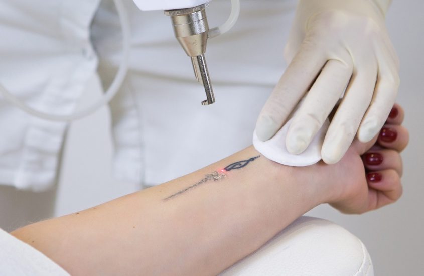Cum se face indepartarea tatuajelor cu laser?
