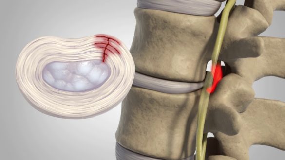 Simptomele herniei de disc cervicale si optiuni de tratament