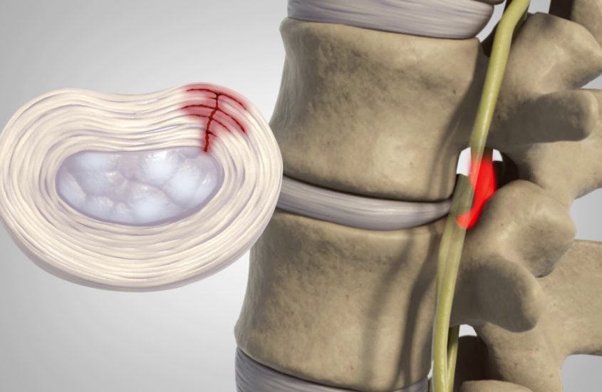 Simptomele herniei de disc cervicale si optiuni de tratament